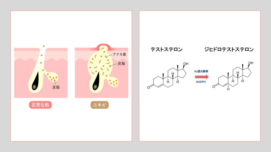 オナ禁とニキビの原因であるジヒドロテストステロン