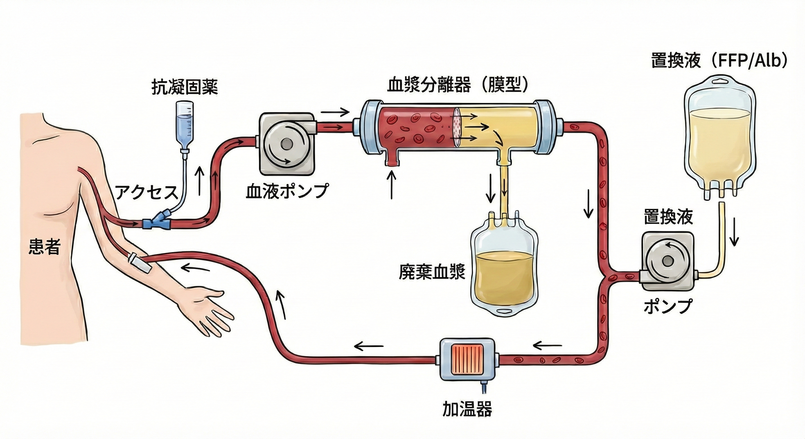 血漿交換の置換液選び｜アルブミンとFFPの違い・メリット・副作用・計算式まとめ